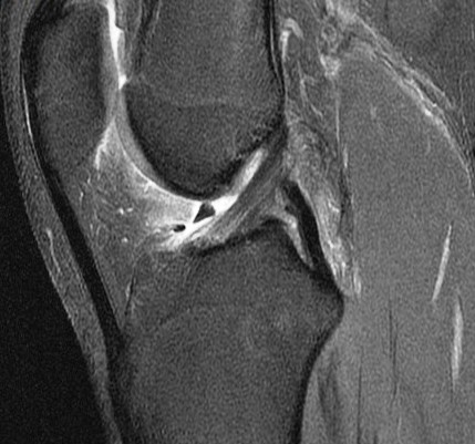 Figure 5 for case Unstable displaced lateral meniscus flap tear( RID2763 )